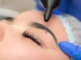 Plasma lift